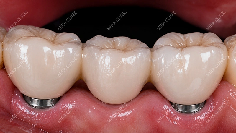 Gum Seal Important Under an Implant-Supported Bridge